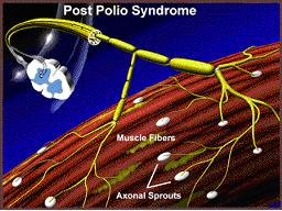 Post-polio Syndrome